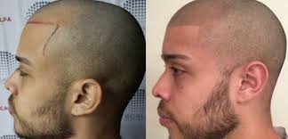 hairline tattoo